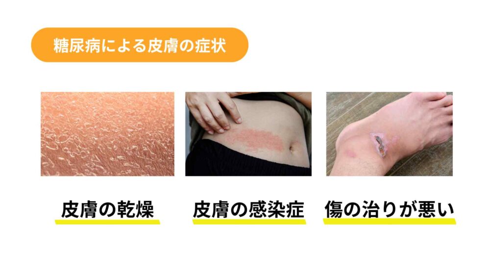 糖尿病の皮膚の症状