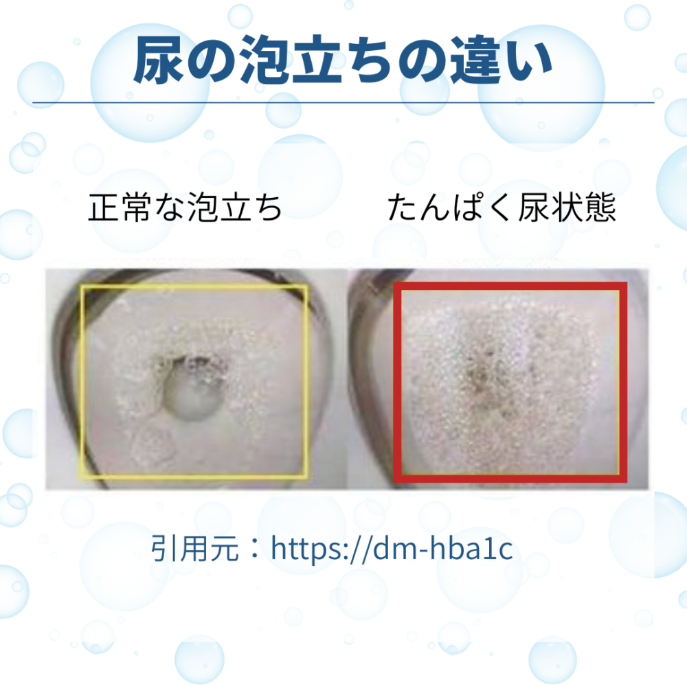 糖尿病による尿の泡立ちの違い